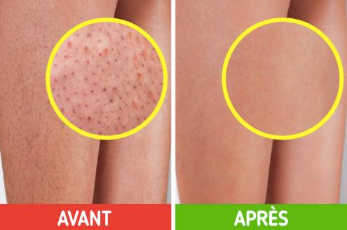 Peau de fraise : causes, solutions et rituel naturel